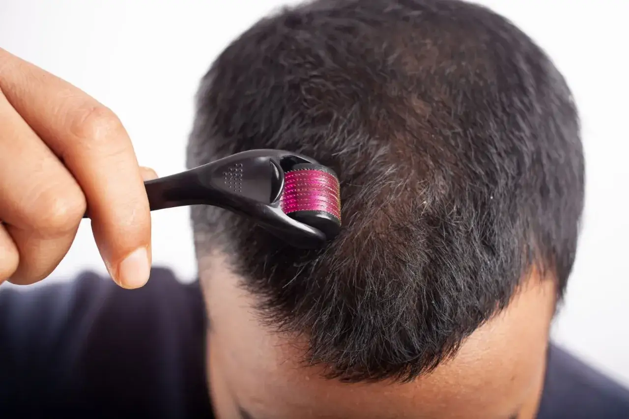 Un homme utilise un dermaroller sur son cuir chevelu, peut-&ecirc;tre pour stimuler la croissance des cheveux, en esp&eacute;rant &eacute;viter les furterer triphasic progressive effets secondaires.